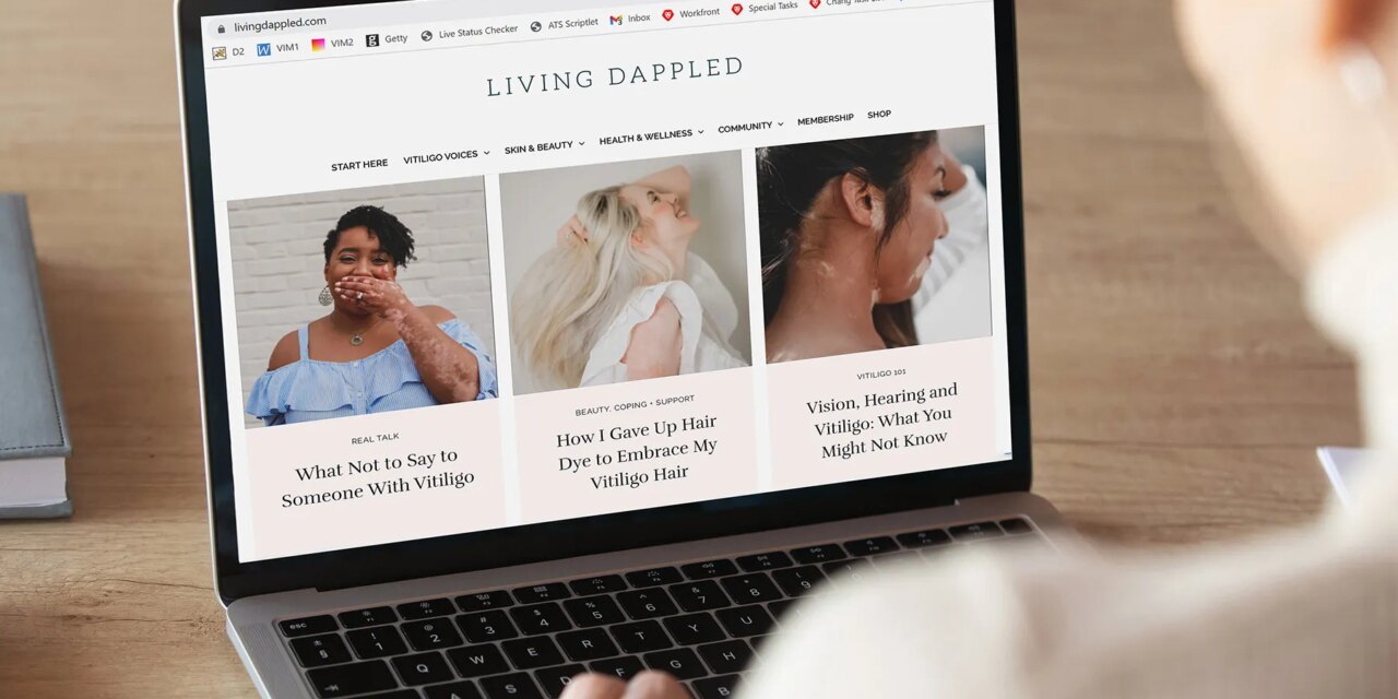 Vitiligo: Find Others Who Share Your Journey