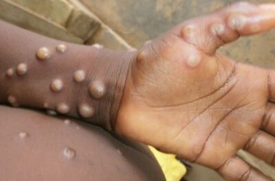 Mpox infections double last year’s rate