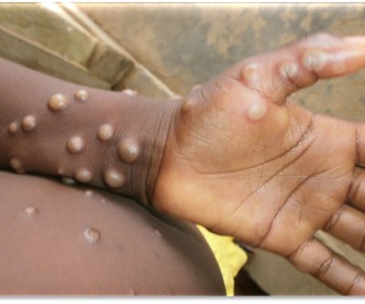 Mpox infections double last year’s rate