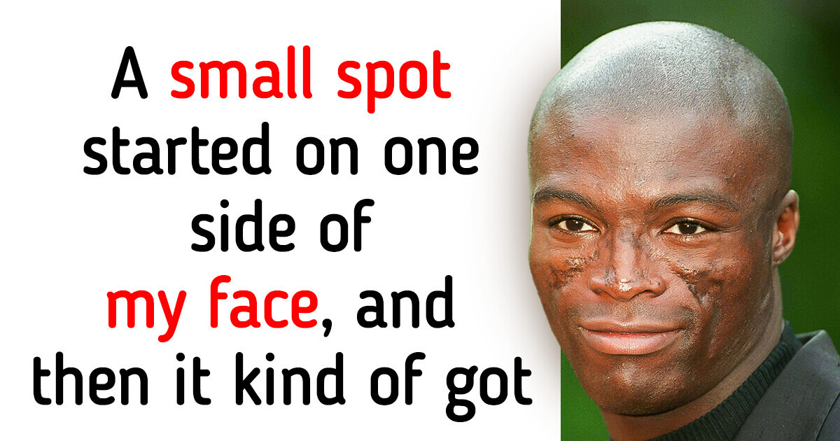 Seal Opens Up About «Traumatizing» Scars on His Face and What Caused Them