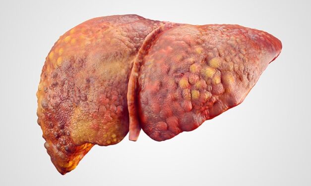 Nutrition Therapy Useful for Alcohol-Related ACLF