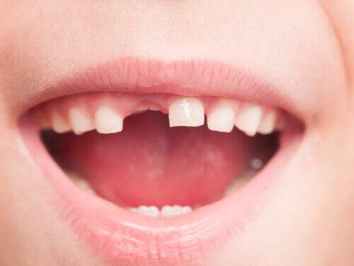 RFK Jr’s plan to ban fluoride supplements will “hurt rural America,” dentists say