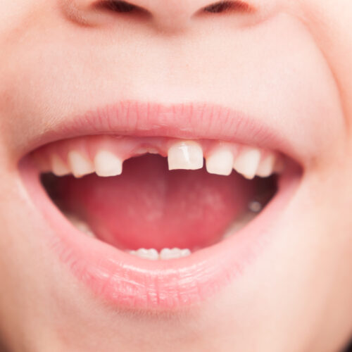 RFK Jr’s plan to ban fluoride supplements will “hurt rural America,” dentists say