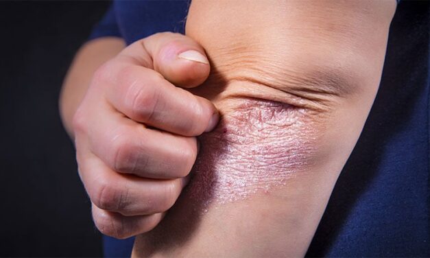 IL-23 Inhibitors Show Highest Drug Survival in Psoriasis