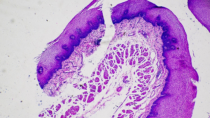 AI-Derived Risk Score May Improve Risk Stratification of Squamous Cell Carcinomas
