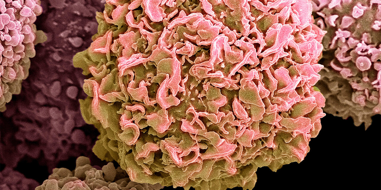 Trends in Global Cancer Cases, Deaths Offer Little Reassurance