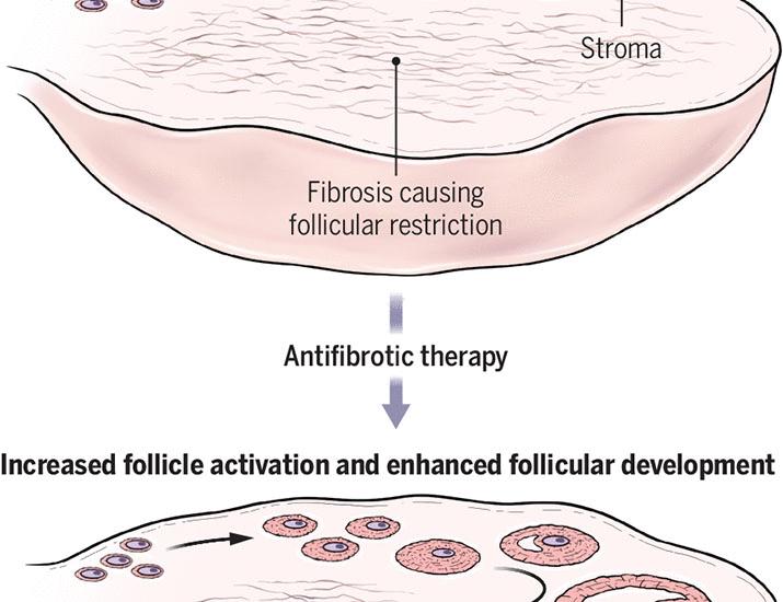 The ovarian stroma as a therapeutic target | Science