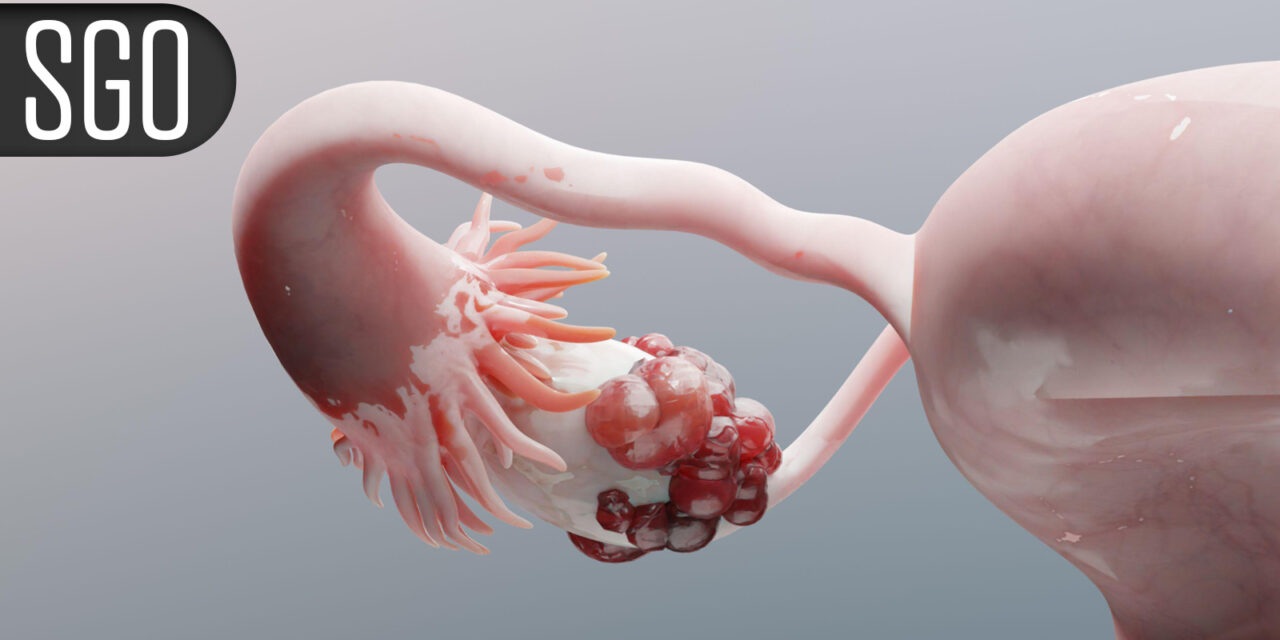 Novel Regimen Boosts Survival for Recurrent Platinum-Resistant Ovarian Cancer