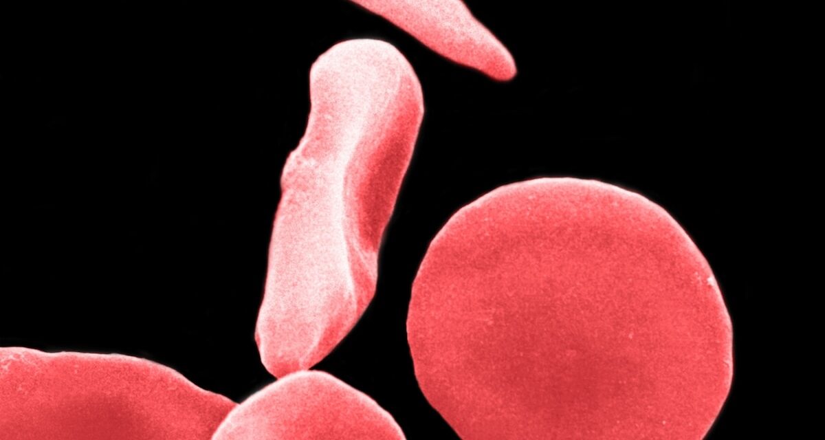 Scientists cured sickle cell. Then their next challenge began.