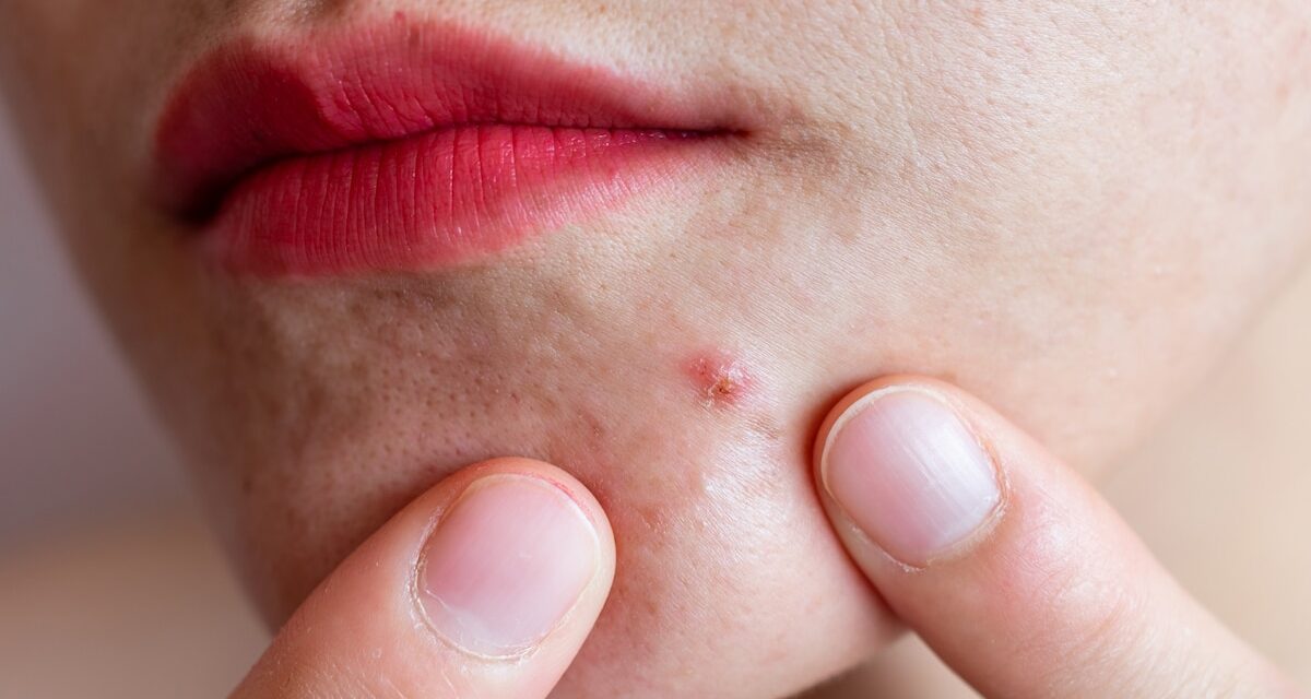 How eczema and acne can affect your mental health