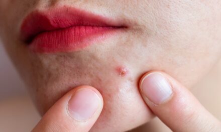 How eczema and acne can affect your mental health