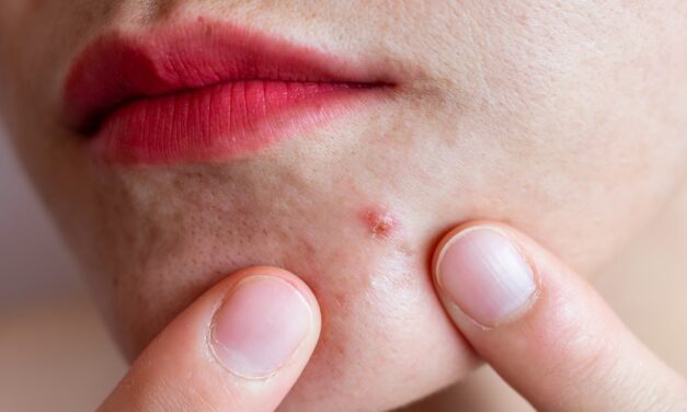 How eczema and acne can affect your mental health