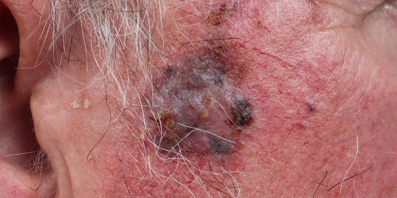 Twice-Rejected Melanoma Drug Gets Surprise Love From FDA Panel