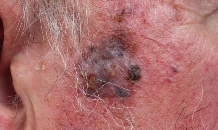 Twice-Rejected Melanoma Drug Gets Surprise Love From FDA Panel